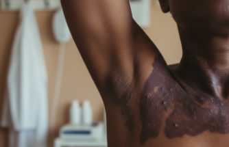 Ciltteki Koyu Lekeler Hastalık Habercisi Olabilir mi?