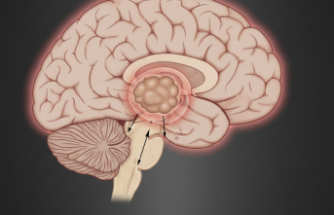 Gözlerdeki Hareket Kısıtlılığına Dikkat: Parinaud Sendromu