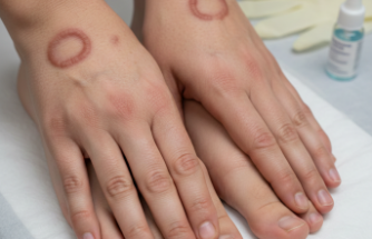 Granüloma Anulare Vakalarında Artış: Uzmanlar Belirtiler Hakkında Uyarıyor