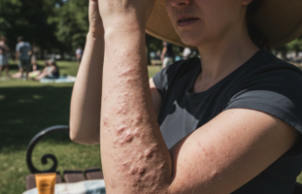 Güneş Işınları Ciltte Reaksiyona Sebep Oluyor