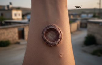 Güneydoğu'nun Geçmeyen İzi: Şark Çıbanı