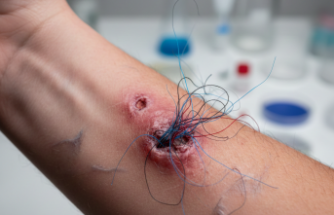 Morgellons Sendromu: Deri Altında Gizemli Lifler