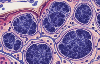 Nadir Görülen Bir Vasküler Hastalık: Blue Rubber Bleb Nevus Sendromu