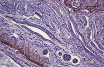 Nadir Görülen Lipoid Proteinosis Vakaları Mercek Altında