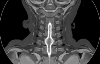 Omuriliğin Sessiz Misafiri: Siringomiyeli