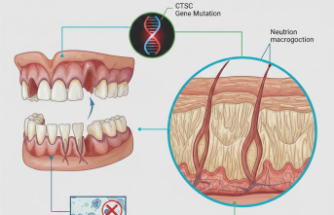 Papillon Lefèvre Sendromu Hakkında Bilinmesi Gerekenler