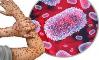 Fabry Hastalığı: Nadir Lizozomal Depo Hastalığının Tedavisinde Yeni Ufuklar Açılıyor